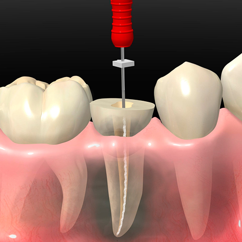endodoncia