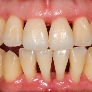 periodontalmente-disminuidos Cirugía plástica periodontal