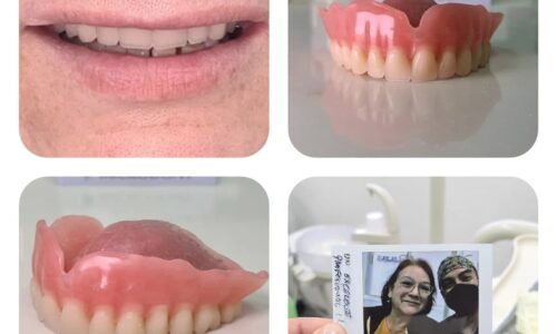 Prótesis dentales tipo removibles en clínica cenn.