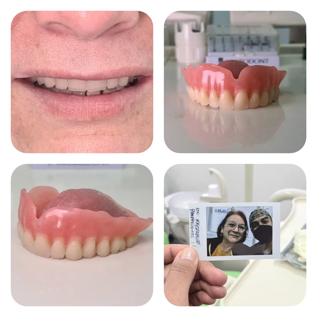 Prótesis dentales tipo removibles en clínica cenn.
