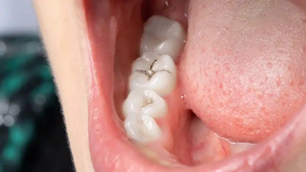 foto de artículo de qué es una caries
