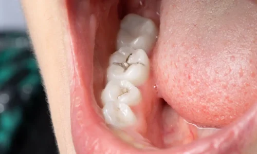 foto de artículo de qué es una caries