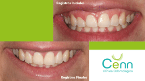 antes y después; gingivectomía y alargamiento coronario