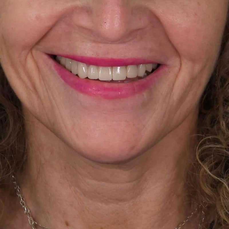 caso-clinico-rehabilitacion-oral