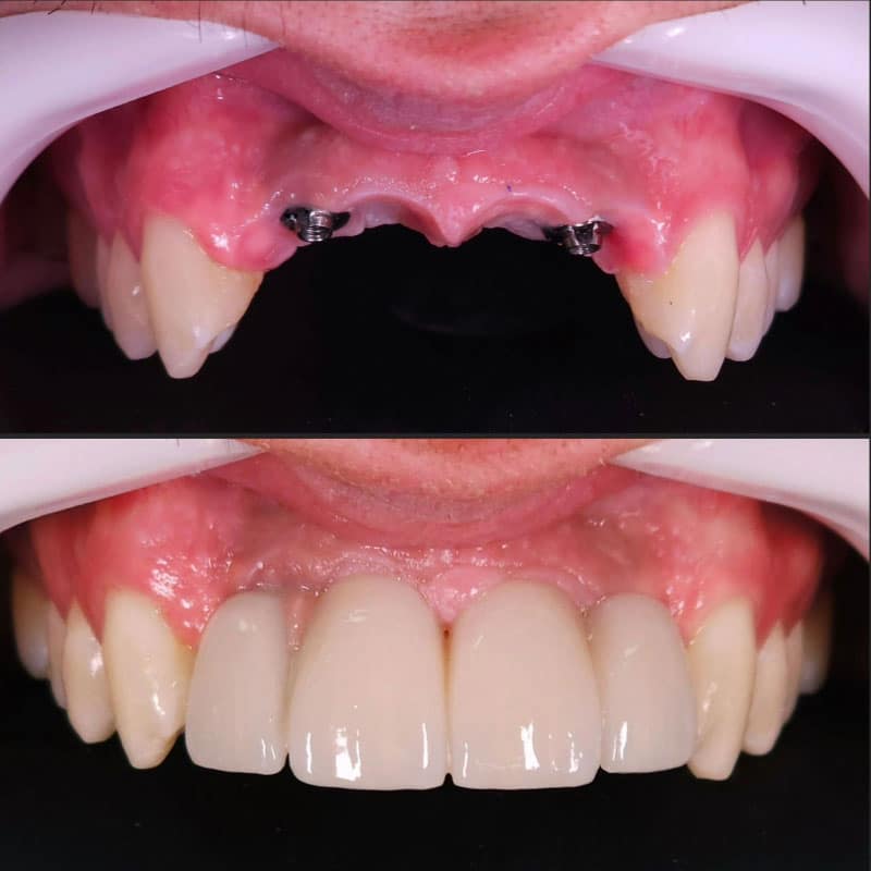 implantes-cenn