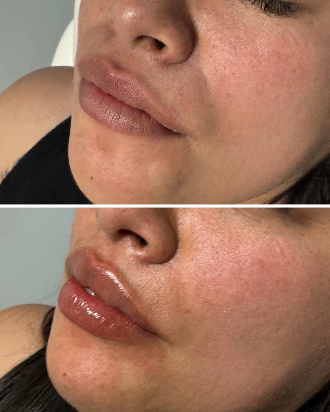 Relleno-labios-cenn (1)