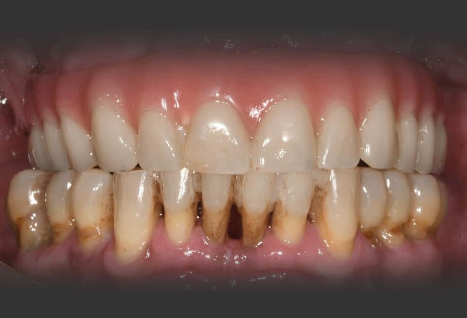 Control-final-tratamiento-periodontitis-cenn
