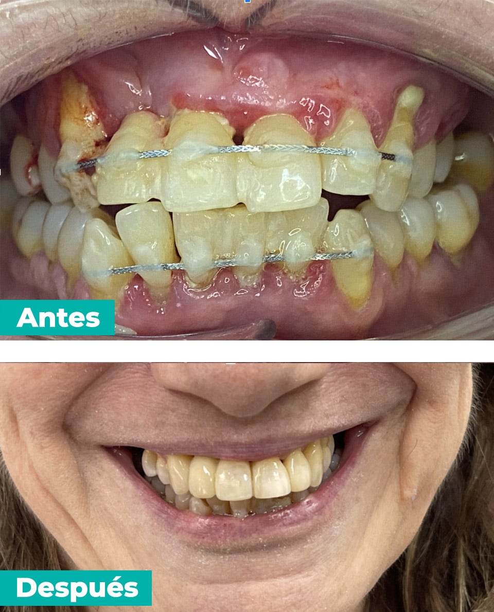 periodontitis-avanzada-1-2-4