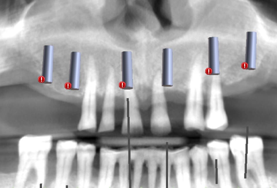 planificacion-digital-periodontitis-cenn