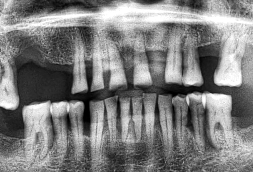 radiografia-dental-periodontitis-cenn