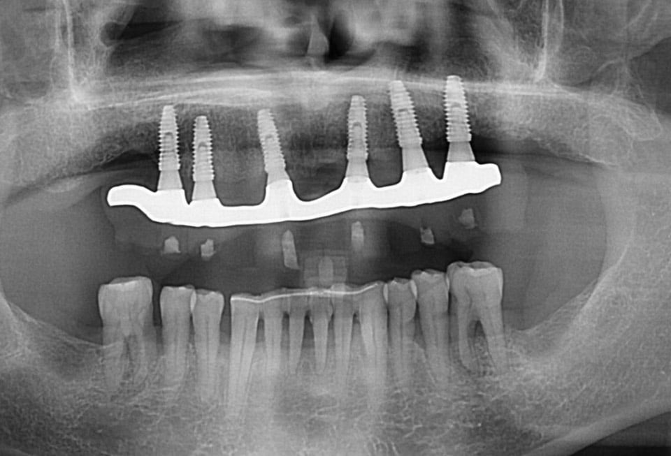 radiografia-protesis-terminada-periodontitis-cenn