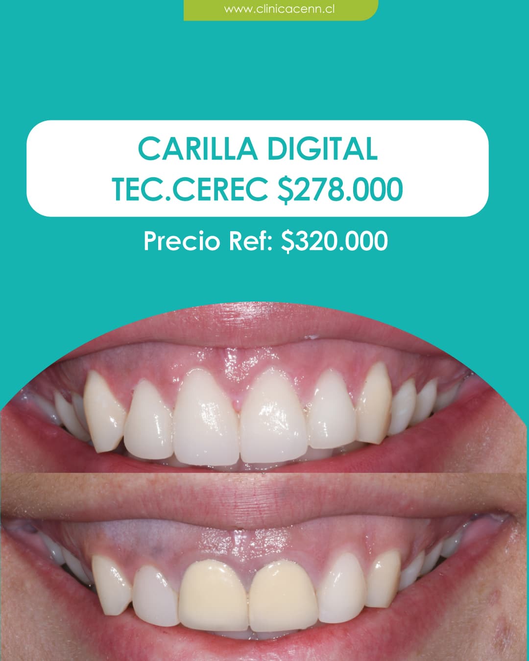 CARILLA DIGITAL TECNOLOGIA CEREC CLINICA CENN
