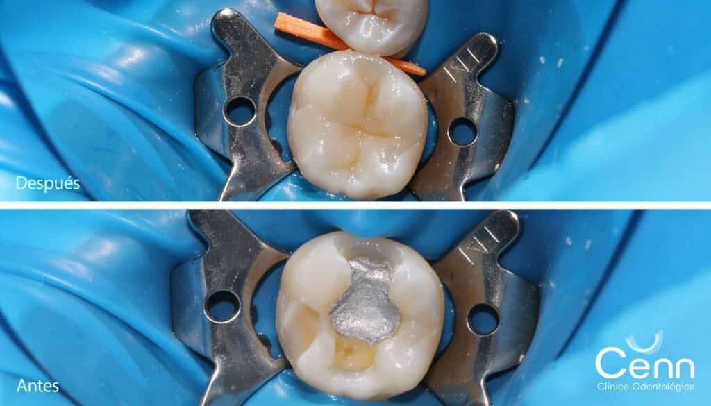 fotografias de antes y despues de colocar una amalgama de resina en clinica cenn