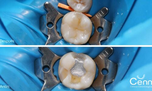 fotografias de antes y despues de colocar una amalgama de resina en clinica cenn