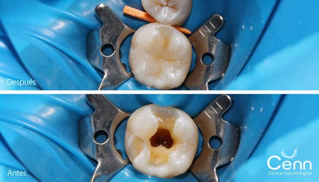 fotografias de antes y despues de colocar una amalgama de resina en clinica cenn