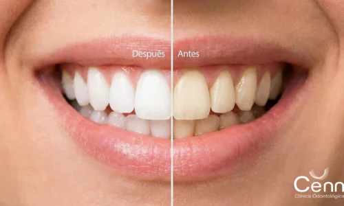 foto de antes y después de un blanqueamiento dental en clínica cenn