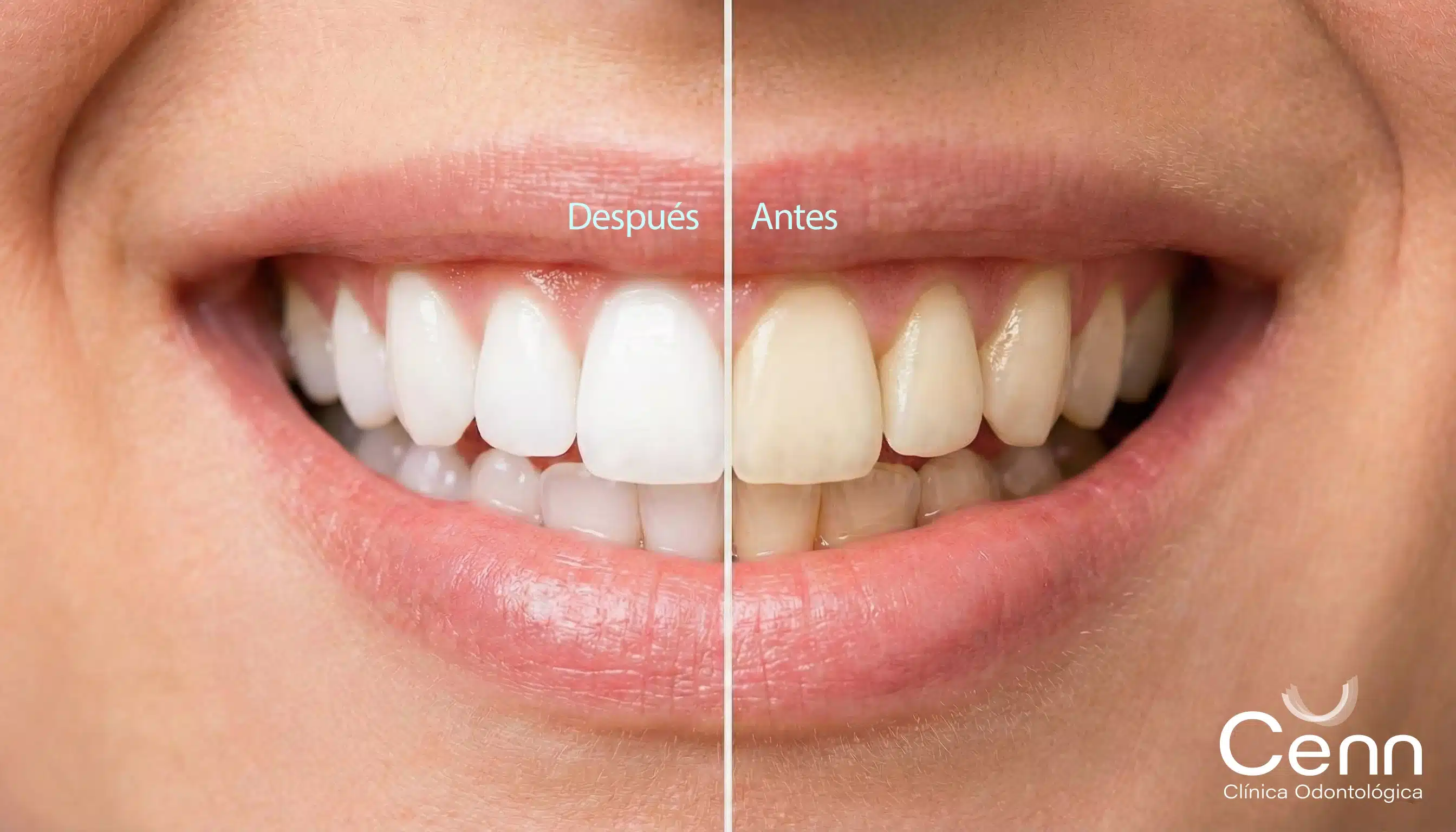 foto de antes y después de un blanqueamiento dental en clínica cenn