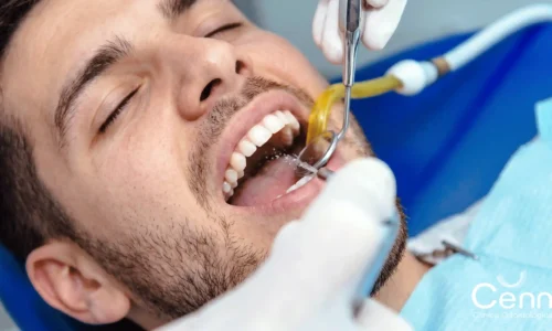 aprende qué es la limpieza dental profunda en clínica Cenn