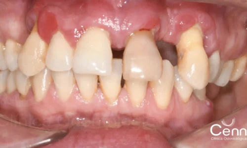 diferencia de periodoncia y periodontitis crónica