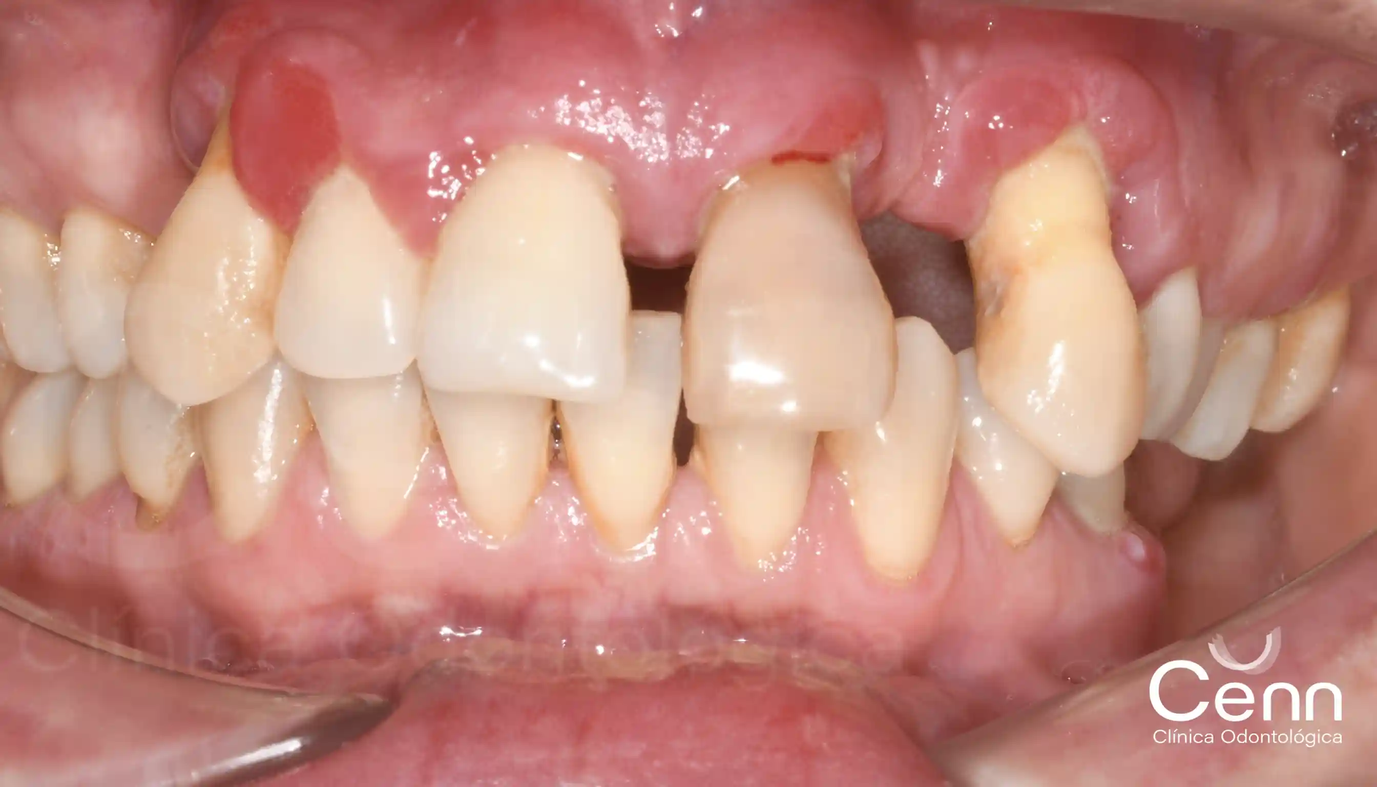 diferencia de periodoncia y periodontitis crónica