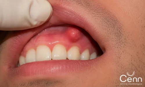 Ejemplo de abseso dental agudo. Clínica Cenn