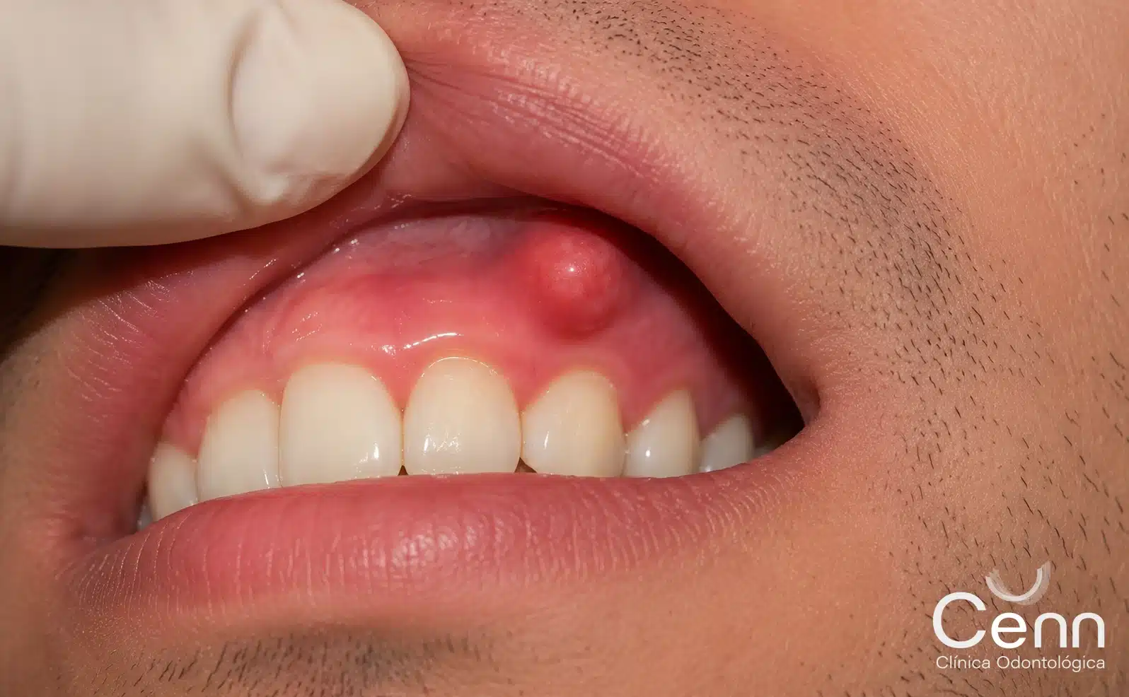 Ejemplo de abseso dental agudo. Clínica Cenn