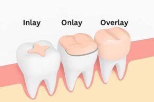 inlay-onlay-overlay